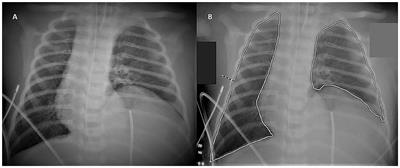 The NeoAPACHE Study Protocol I: Assessment of the Radiographic Pulmonary Area and Long-Term Respiratory Function in Newborns With Congenital Diaphragmatic Hernia